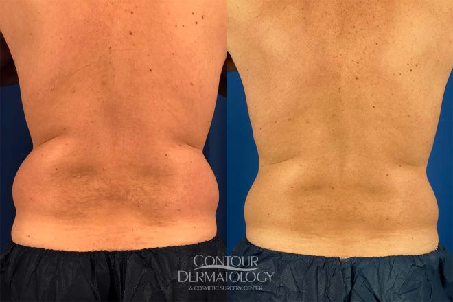 Coolsculpting Flanks and Back 1 treatment