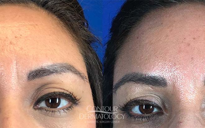 Botox Glabella
