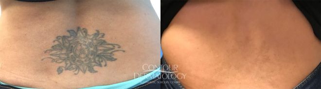 Picoway Tattoo 3 treatments