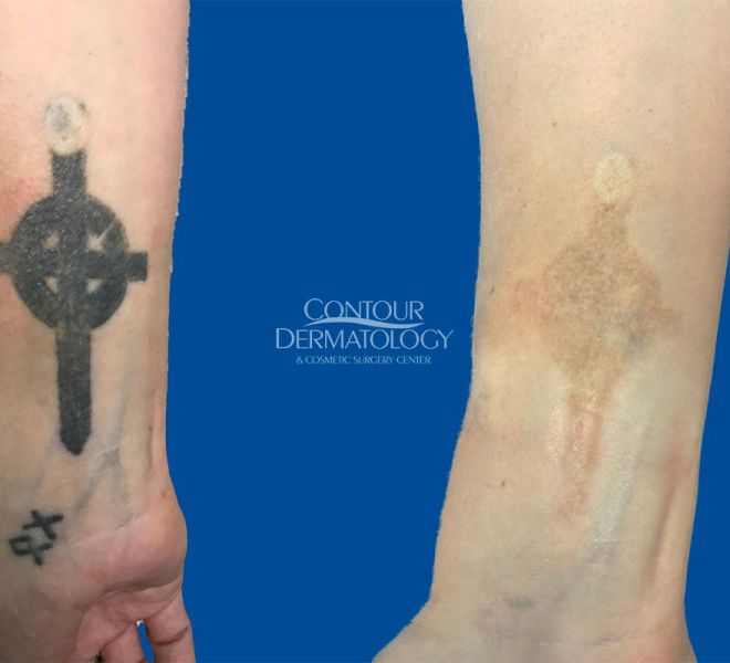 Picoway Tattoo Removal 4 treatments