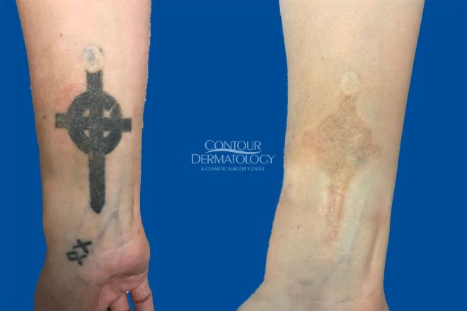 Picoway Tattoo Removal 4 treatments