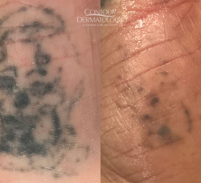 Picoway Tattoo Removal 3 treatments
