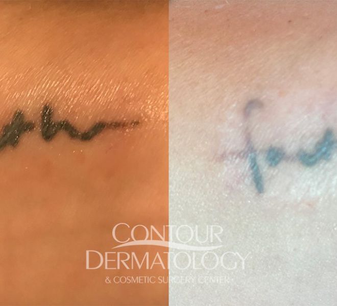 Picoway Tattoo removal 5 treatments