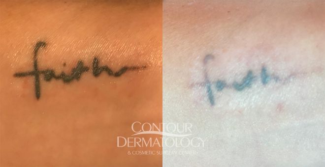 Picoway Tattoo removal 5 treatments