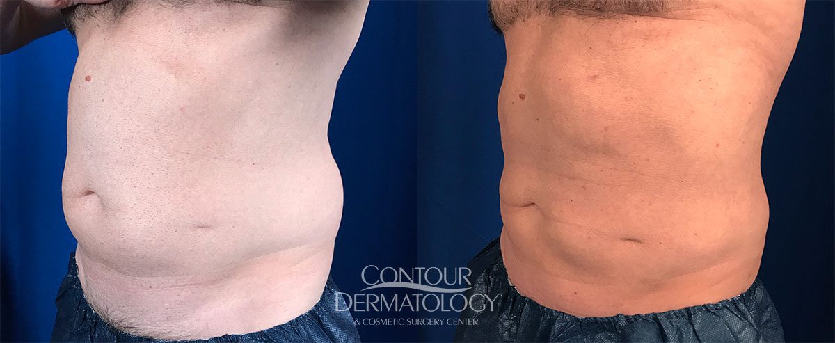 Liposculpture, 2 months after, 29-year-old male