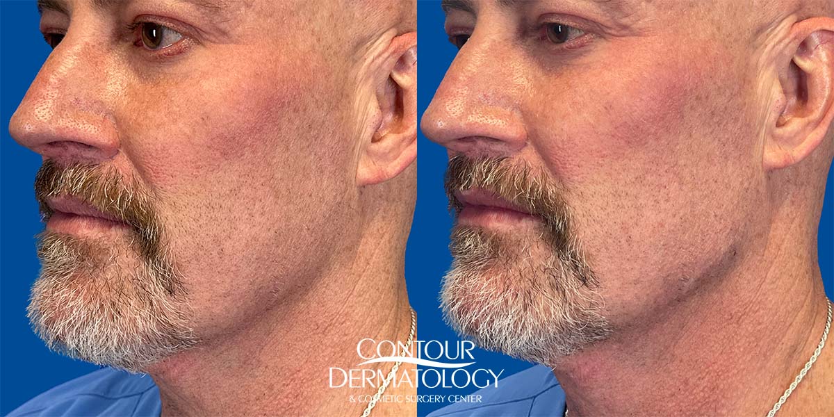 Juvéderm Volux Before and after, Jawline, 56 year old man.